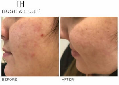SkinCapsule CLEAR+ Supplement for Breakouts