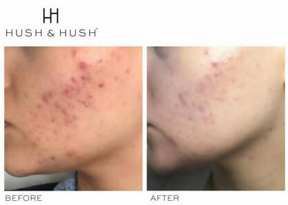 SkinCapsule CLEAR+ Supplement for Breakouts